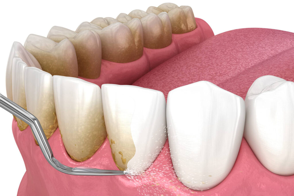 Root Planning Process Scaling and Root Planning - CXC Dental